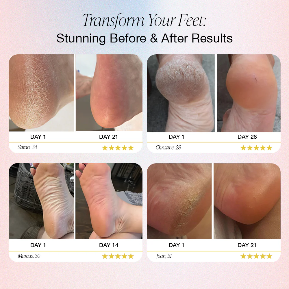 Dermave™ - Electric Foot Callus Remover - Image 6